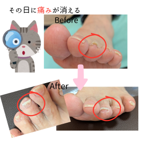 看護師のフットケアと巻き爪補正　〜あしゆめ〜のトッピック画像1