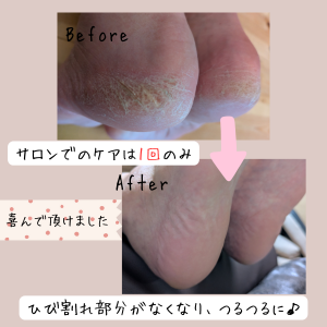 看護師のフットケアと巻き爪補正　〜あしゆめ〜のトッピック画像2