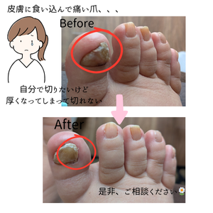 看護師のフットケアと巻き爪補正　〜あしゆめ〜のトッピック画像3
